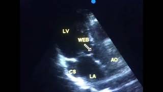 Sub aortic stenosis is it a congenital heart disease  to drahmadmirdamadisiKiJIzZBvYvqoKkZ [upl. by Innoc777]