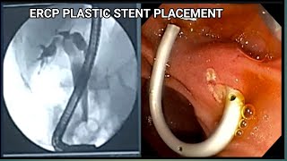 ERCP Plastic stent Placement BDENDOSCOPY [upl. by Gnat512]