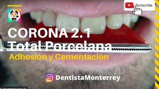 CORONA Anterior de PORCELANA con POSTE de ZIRCONIA👅Parte4 Cementación Adhesión coronadental [upl. by Bast836]