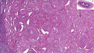 Neuroendocrine Tumor  Appendix  Histopathology [upl. by Suiratnauq]