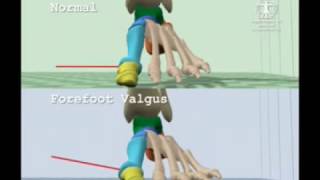 Comparison of Normal Gait to Forefoot Valgus Gait [upl. by Macmahon]