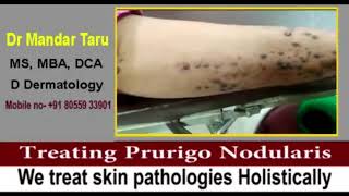 Treating Prurigo Nodularis skin condition [upl. by Zolnay]