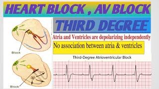 THIRD DEGREE HEART BLOCKAV BLOCKATRIOVENTRICULAR BLOCKأنسداد الدفيرة الكهربائيةأحصار القلب [upl. by Heigl]