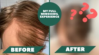 I Have Been Using Minoxidil For 1 Year And Here Are The Results  My Full Minoxidil Experience [upl. by Nevs441]