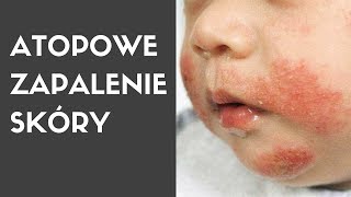 Dermatolog mówi o ATOPOWE ZAPALENIE SKÓRY [upl. by Enerol]