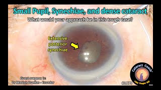 CataractCoach™ 1879 small pupil synechiae and dense cataract [upl. by Lindgren96]