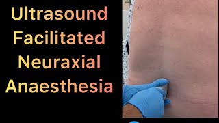 Ultrasound Guided Neuraxial Anaesthesia  step by step how to do it easy and simple👍👌 [upl. by Aened967]