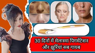 Derma Roller For Melasma Pigmentation And Wrinkles  How To Use Derma Roller On Face At Home [upl. by Brooks]