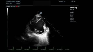 Transtoracic Echo Congenital aneurysm  Aneurisma Congénito por Ecocardiografia Transtorácica [upl. by Butcher]