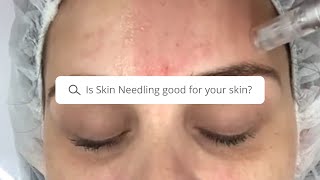 Is Skin Needling good for your skin  Results Laser Clinic [upl. by Sicnarf]