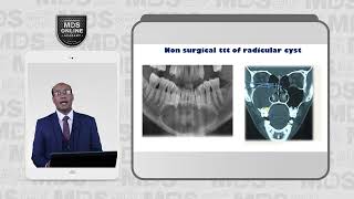 4 5 Radicular Cyst Treatment [upl. by Rosabel]