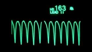 Arrêt cardiaque sur IDM monitorage ECG [upl. by Zetra]