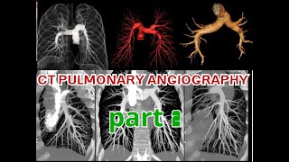 طريقة عمل الأشعة المقطعية بالصبغة على الشريان الرئوي بالتفصيل جزء2 CT Pulmonary Angiography [upl. by Whitehouse]