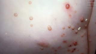 Molluscum Contagiosum PopTALK Dermatology diagnosis discussion [upl. by Ravi192]