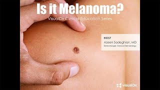 Is it melanoma [upl. by Junna]