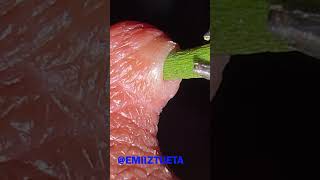 Splinter Removal super fast Satisfying 100 [upl. by Ronda]