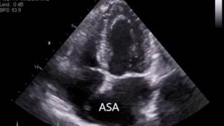 Atrial Septal Aneurysm ASA [upl. by Buell653]