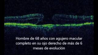 Cirugía de agujero macular  Nueva técnica con inducción de desprendimiento macular [upl. by Incrocci293]