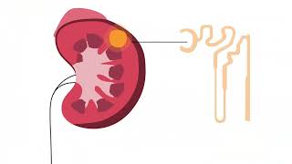 What is Chromophobe Renal Cell Carcinoma [upl. by Atsuj]