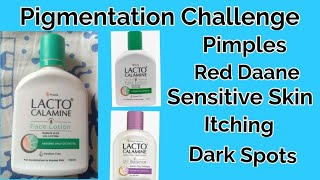 Pigmentation challenge Lacto calamine face lotion for itching pimples sensitive skin red skin [upl. by Erlond]