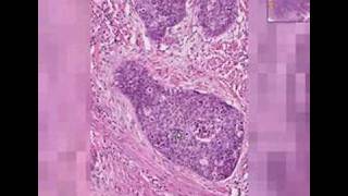 Histopathology Cervix Squamous cell carcinoma [upl. by Fremont394]