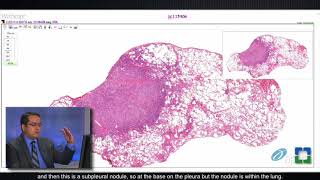 Lung Granulomas Caused by Fungal Infection [upl. by Vieva12]