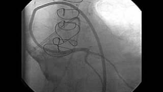 Left Ventricular Dysfunction after Heart Transplantation [upl. by Willumsen]