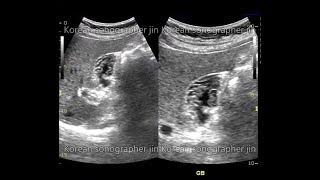 Sonography of GB 담낭초음파GB polypAdenomyomatosis of GBGB stone CholecystitisCholangiocarcinoma [upl. by Aicilaanna]