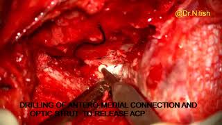 EXTRADURAL ANTERIOR CLINOIDECTOMY  OPTHALMIC ARTERY ANEURYSM CLIPPING [upl. by Arua]