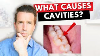 What Causes Cavities  Everything You Need To Know [upl. by Therine]