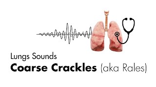 Coarse Crackles Rales  Lung Sounds  Medzcool [upl. by Elleiad]