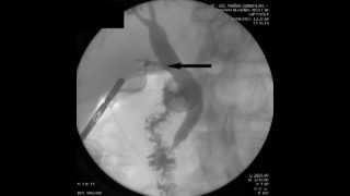 Intraoperative cholangiography [upl. by Pressey]