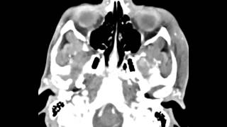 Mandibular Condyle Osteochondroma [upl. by Attenyw]