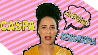 Alergia no couro cabeludo  Minha experiência [upl. by Annaeoj]