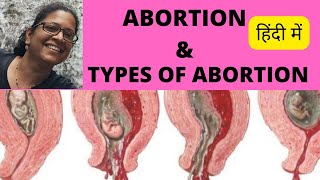 AbortionTypes of abortion in obstetricsTypes of abortion and managementAbortion types hindi [upl. by Gwyn]