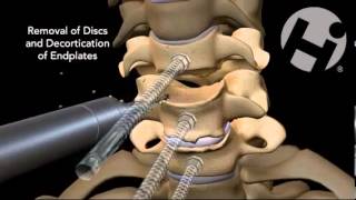 CERVICAL SURGERY C5C6C7 [upl. by Caron]