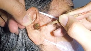 GrandMa Has Something HUGE Stuck Inside Her Ear [upl. by Annoya845]