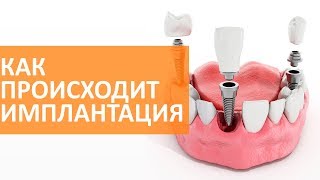 🔵 Основные этапы имплантации зубов  Семейный доктор [upl. by Brownley]