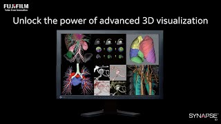 Explore Bilateral Acute Pulmonary Thromboembolism with Sceneria View and Synapse3D Technology [upl. by Arataj]