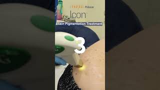 Skin Pigmentation Treatment Icon Laser [upl. by Zadack]