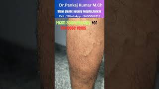 Foam Sclerotherapy treatment for varicose veins Varicose veins treatment before SSC GD medical [upl. by Combs]