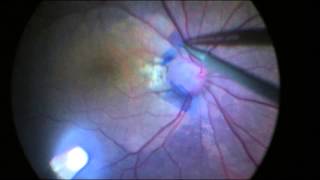 Surgical Treatment of Optic pit maculopathy [upl. by Joash930]