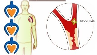 Thrombosis  What is it and how is it treated [upl. by Raymund]