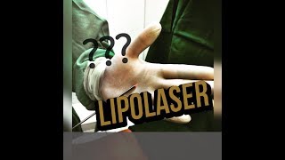 LIPOLASER  VIBROLIPO OU LIPO CONVENCIONAL QUAL ESCOLHER [upl. by Keefe278]