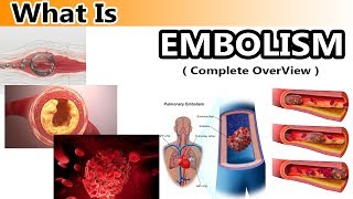 What is Embolism  Clear amp Complete Overview [upl. by Leclair]