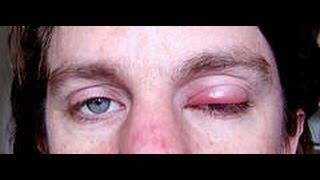 How To Get Rid Of A Stye  how to get rid of styes  eye stye treatment [upl. by Grochow]