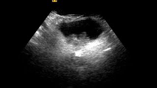 Urinary Bladder Mass  Differential Diagnosis [upl. by Airamesor]