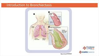 Introduction to Bronchiectasis with Tim Aksamit MD [upl. by Ainos]