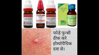 Boils homoeopathic medicine फोड़ों और फुंसी दूर करे by carewell homoeopathy [upl. by Arracot]