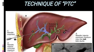 Percutaneous Transhepatic Cholangiography Cerebral Angiography  Specialized VIR Procedures Prt 1 [upl. by Blodget]